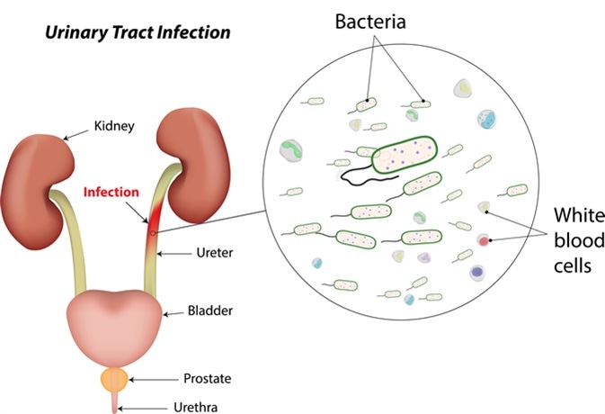 Tips to Prevent Urinary Tract Infections